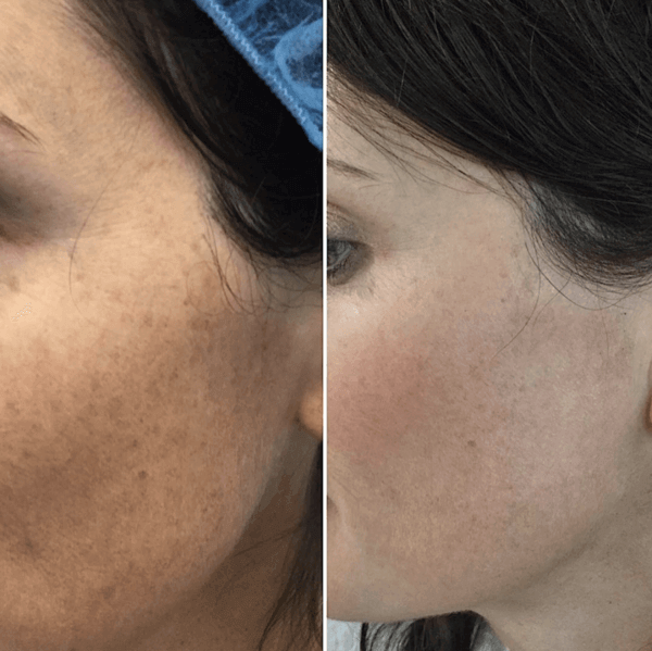 JUVIVE - Women & Pediatric Dermatologist in Newport Beach - Before & After Photos