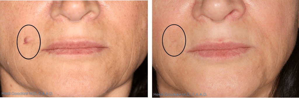 JUVIVE - Women & Pediatric Dermatologist in Newport Beach - Cosmetic Mole Removal
