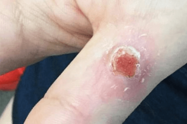 JUVIVE - Women & Pediatric Dermatologist in Newport Beach - Wart Removal