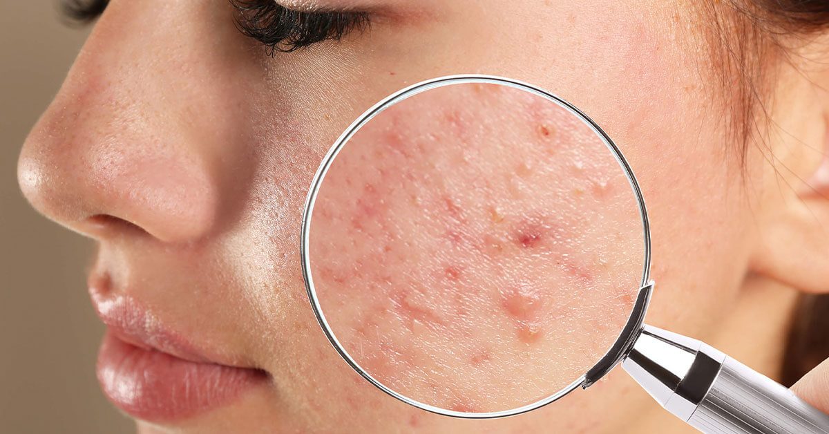 JUVIVE - Blog - Teenage Acne: What Causes It and How Can Parents Help?