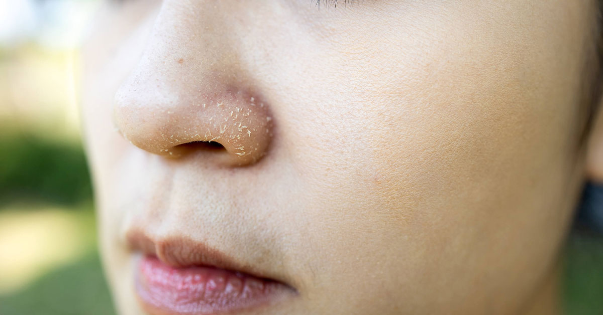 JUVIVE Blog - 5 Early Warning Signs of Eczema on Your Face